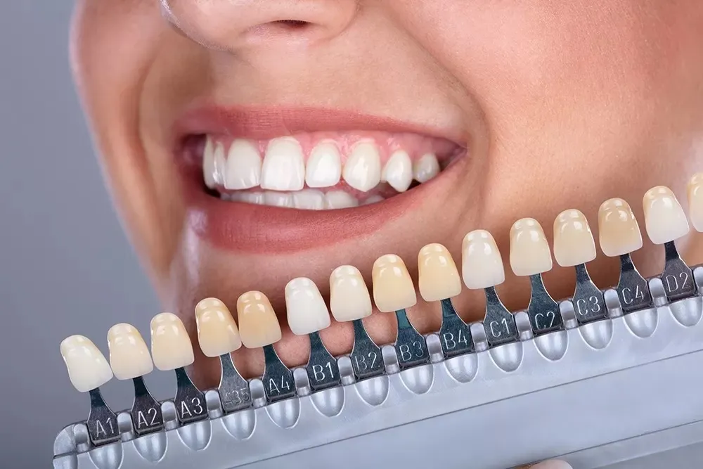 Cosmetic Veneers/Bonding image 1
