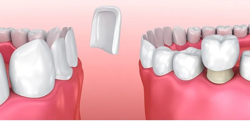 Ceramic Veneers / Crowns image 2