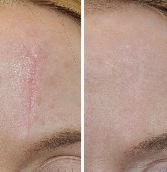 Scar Revision image 1