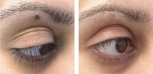 Skin tag and mole excision image 1