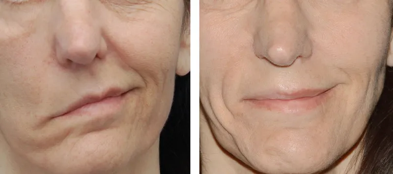 Facial Paralysis Surgery image 1