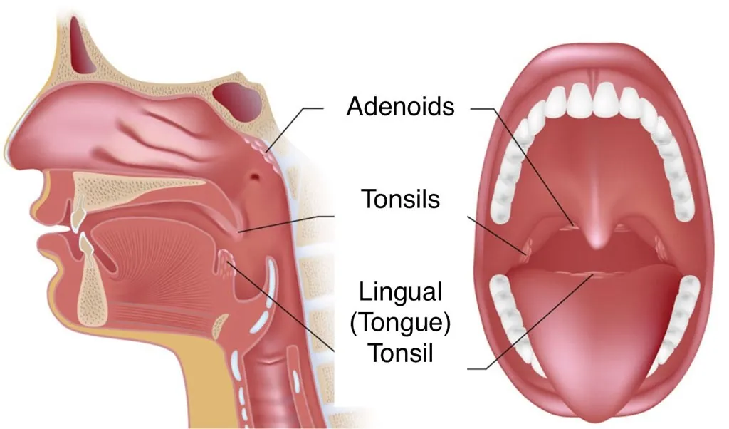 Tongue Reduction Surgery image 1