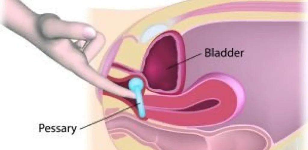 PROLAPSE AND URINARY PROBLEMS image 1