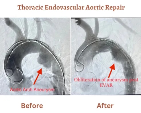 Endovascular Aortic Repair (EVAR) image 1