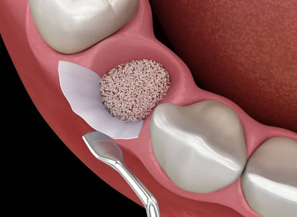 Alveolar Bone Augmentation image 1