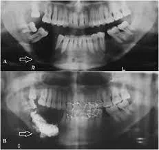 Jaw Cyst And Tumor Surgery image 1