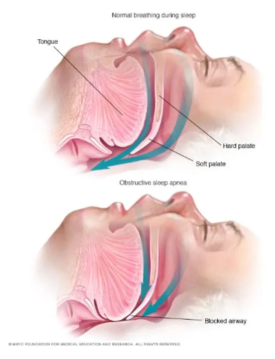 Obstructive Sleep Apnea & OSA image 1