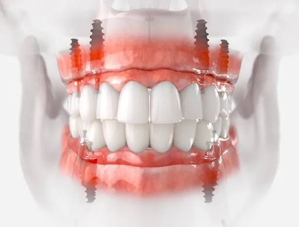 Jaw Implants image 1