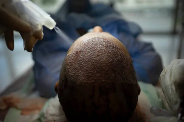 Hair Transplant image 1