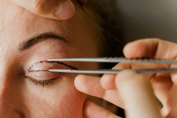 Cosmetic Eye Surgery (Blepharoplasty) image 1