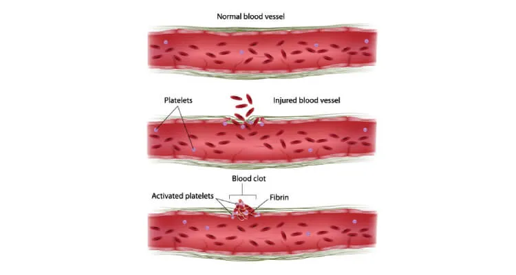 Bleeding Disorders image 1