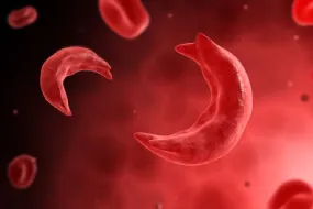 Hemoglobinopathy image 2