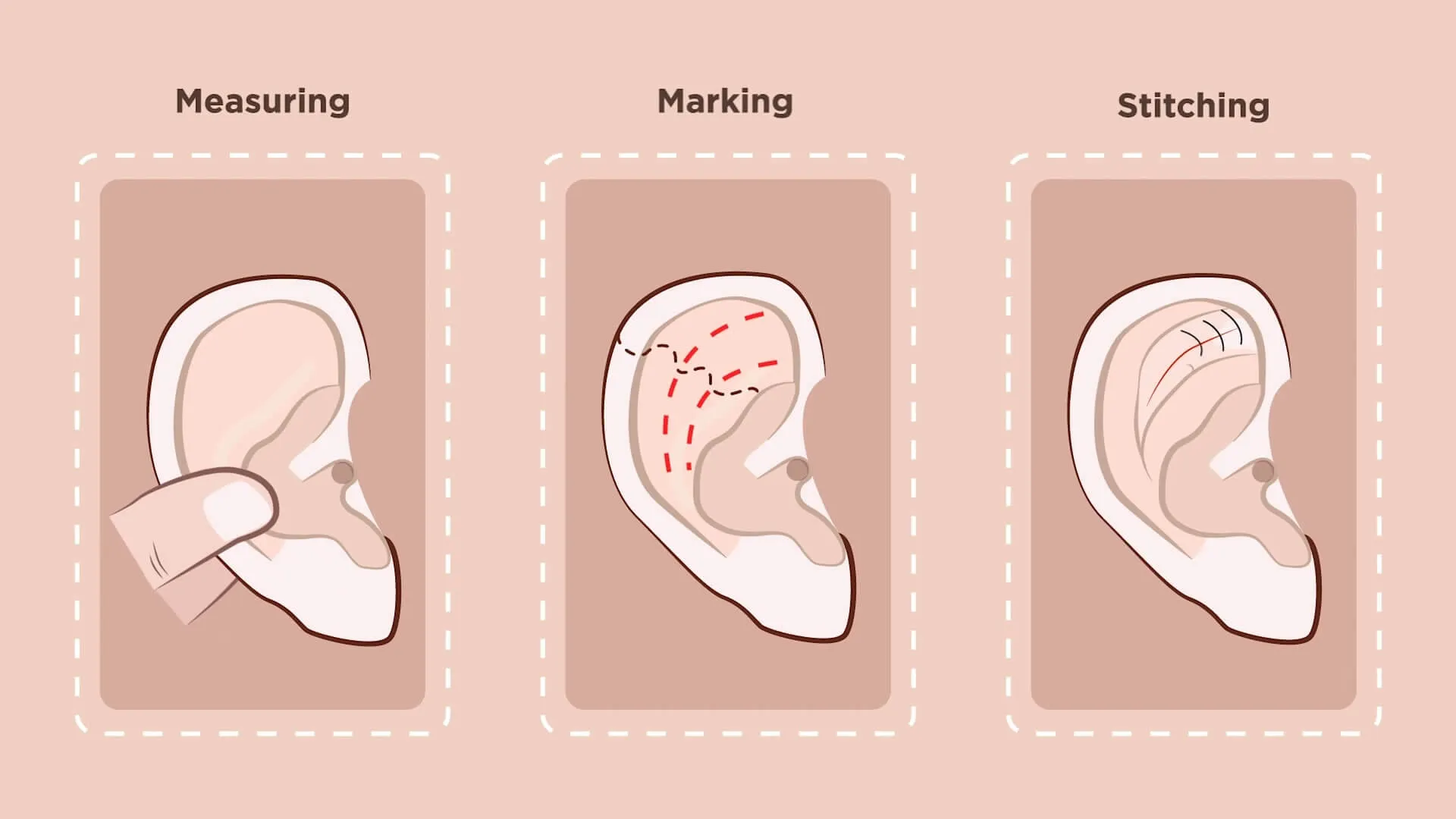 Prominent Ear Surgery image 1