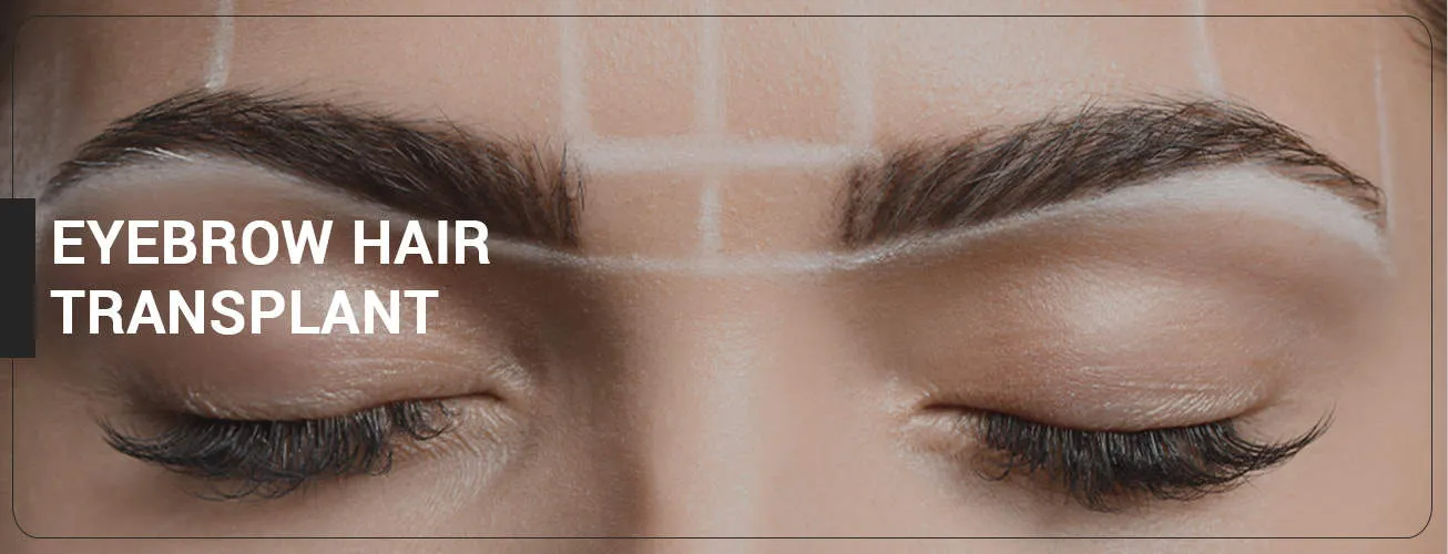 Eyebrow Transplantation image 1