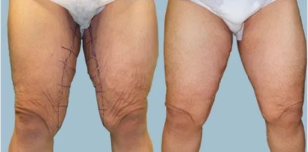Thigh Plasty image 2