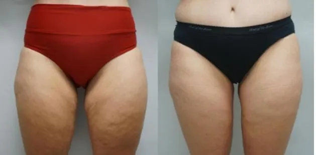 Thigh Plasty image 3
