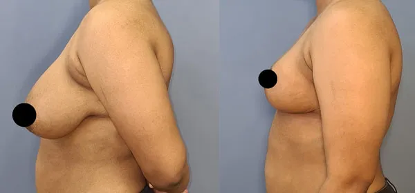 Breast Reduction & Lift image 3