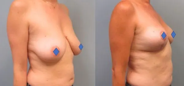 Breast Reduction & Lift image 4