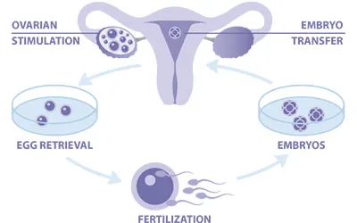 IVF: In-vitro Fertilization image 1