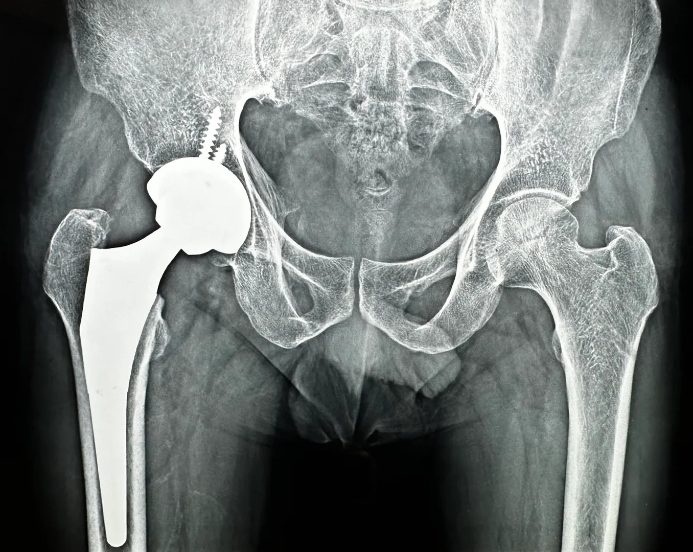 Hip replacement surgery image 1