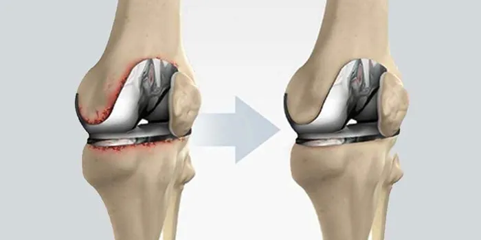 Revision Joint Replacement image 1