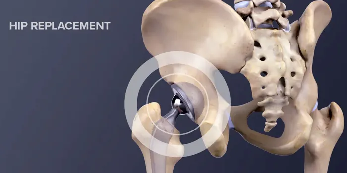 Hip Replacement image 1