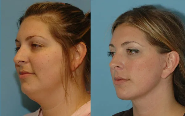 Neck Lift image 2