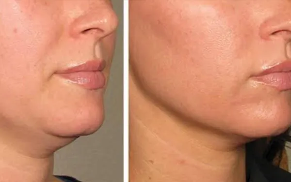 Neck Lift image 3