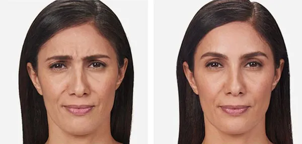 Botox And Fillers image 2