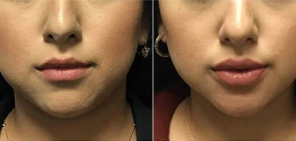 Botox And Fillers image 3