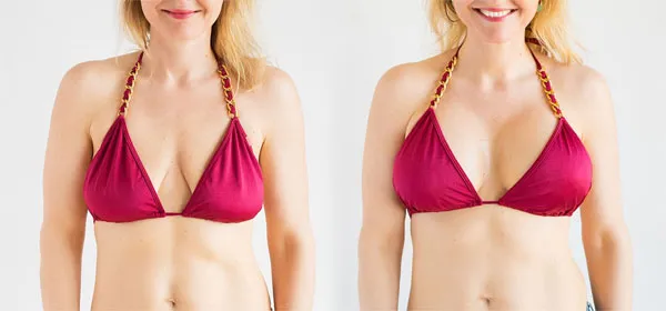 Breast Surgery-Augmentation image 2