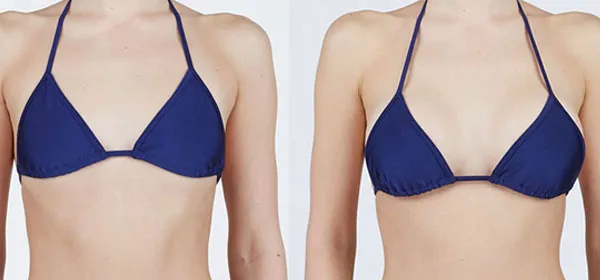 Breast Surgery-Augmentation image 3