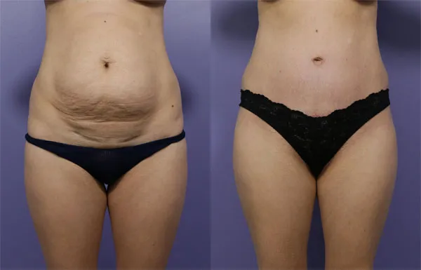 Abdominoplasty image 3