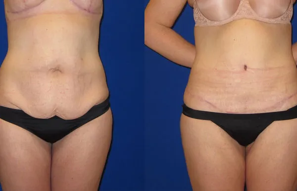 Abdominoplasty image 2