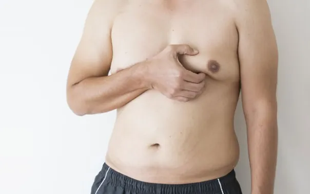 Gynecomastia image 1