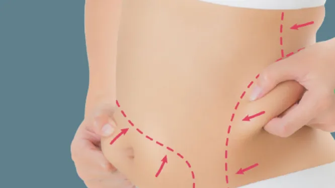Liposuction-Abdominal Liposuction image 1