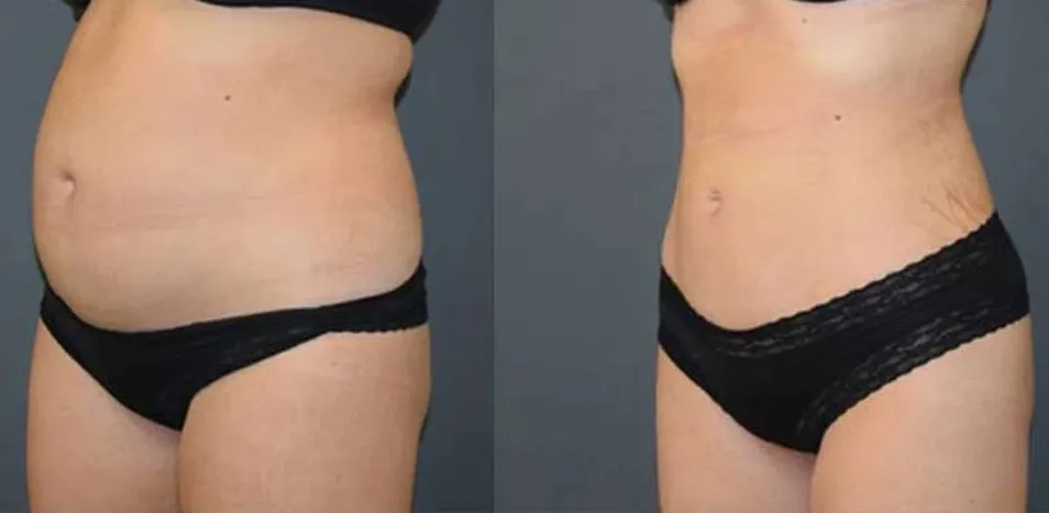 Liposuction-Abdominal Liposuction image 2