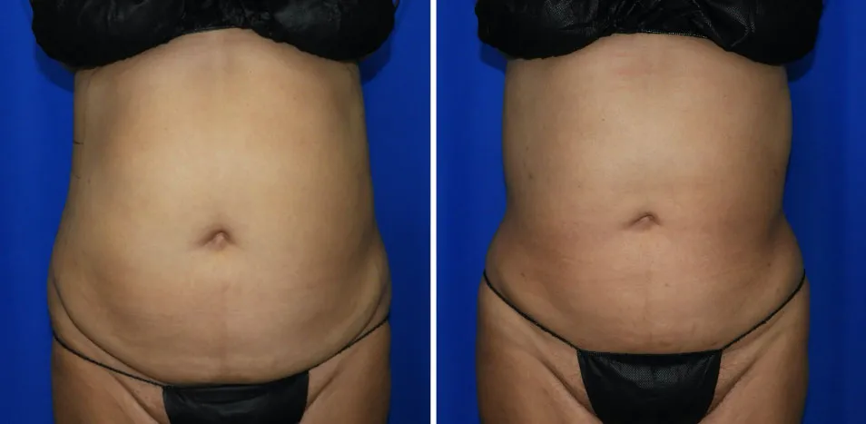 Liposuction-Abdominal Liposuction image 3