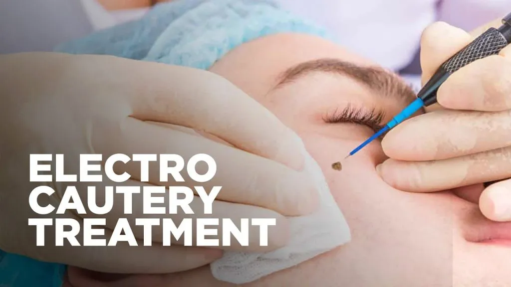 ELECTROCAUTERY image 1