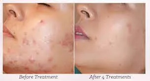 MESOTHERAPY FOR ACNE  image 1