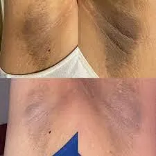 UNDERARMS WHITENING  image 1