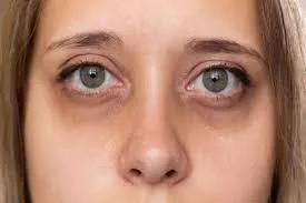 DARK CIRCLES TREATMENT  image 1