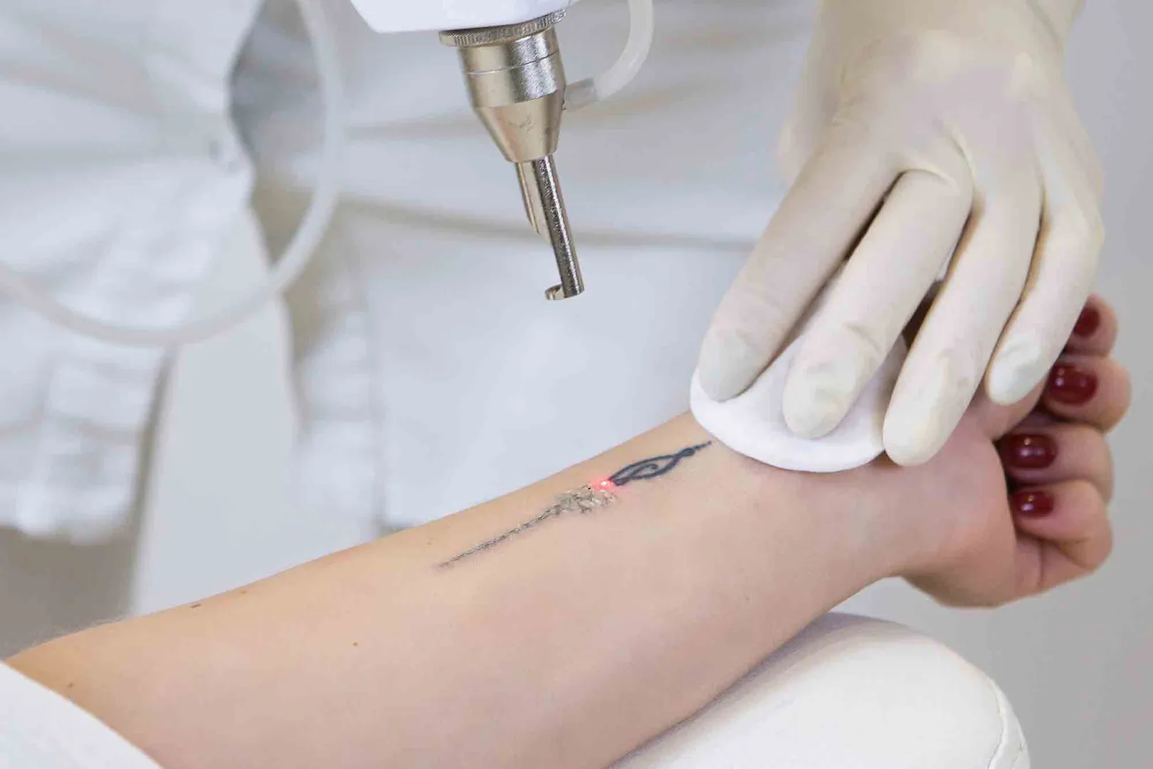 TATTOO REMOVAL  image 1