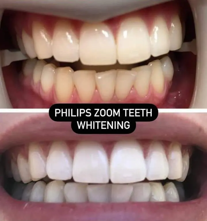 Philips Zoom Teeth Whitening  image 1
