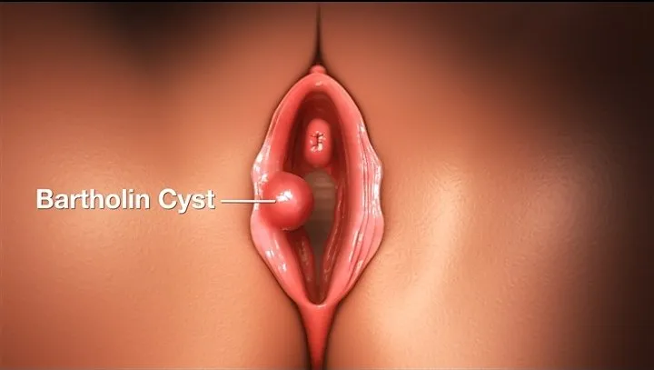Bartholin's Cyst Surgery image 1