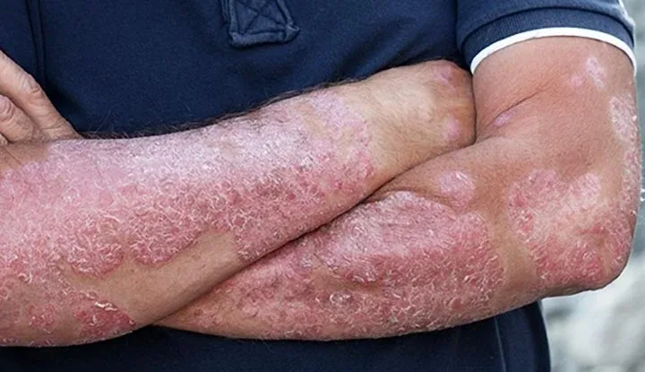 Treating Psoriasis with Integrative Approach  image 1