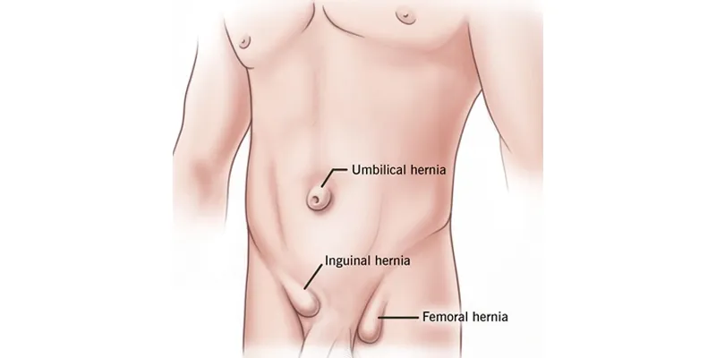Hernia Surgery  image 1