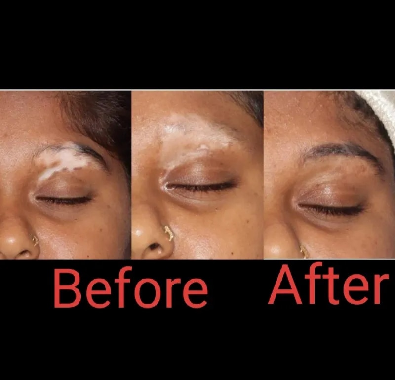 PRP THERAPY For VITILIGO(WHITE PATCHES ) image 1