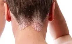 Skin Disease image 1