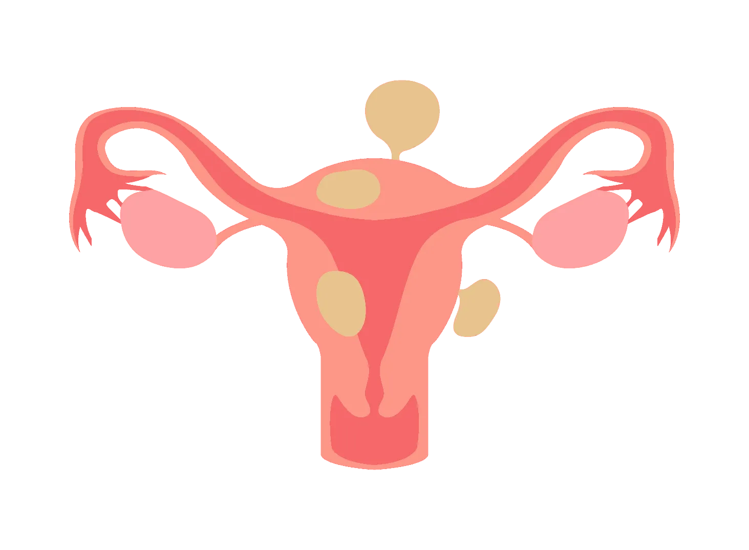 Uterine Fibroid Removal Doctor in Balewadi,Baner,Pune image 1
